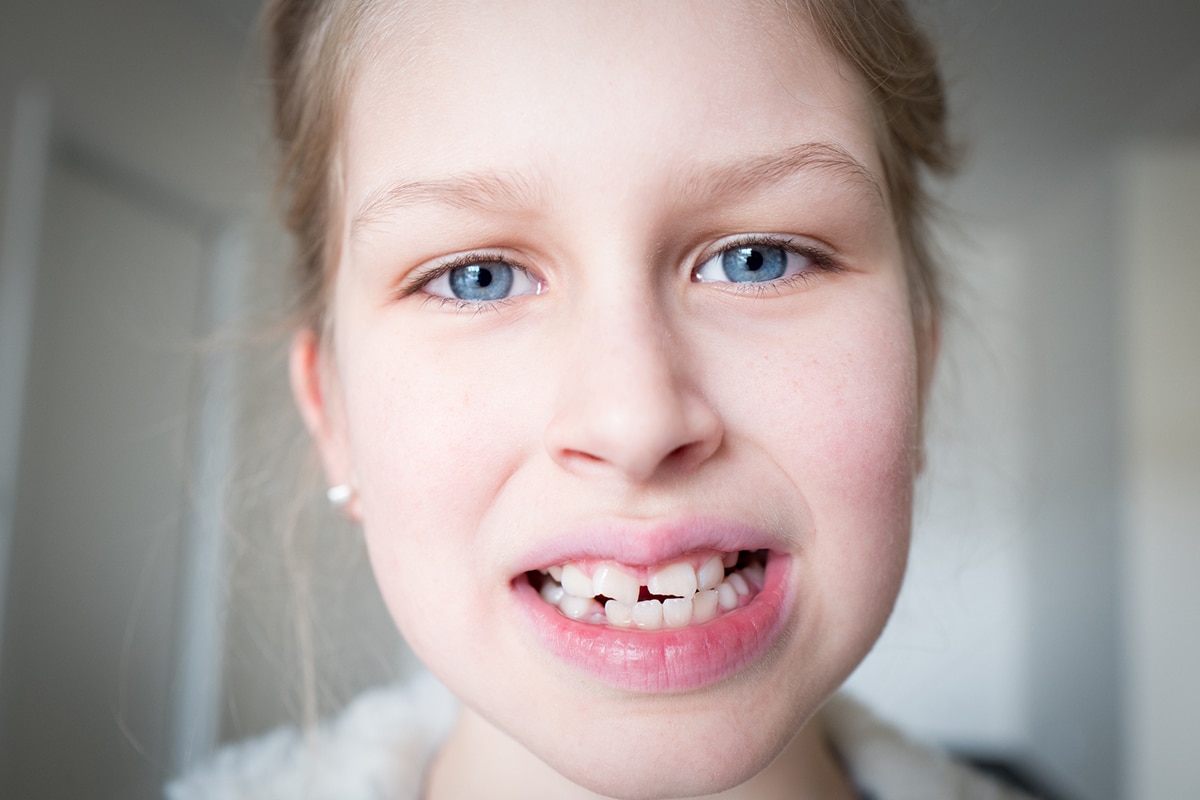 Chipped or cracked tooth in a child what to do before seeing the dentist blog