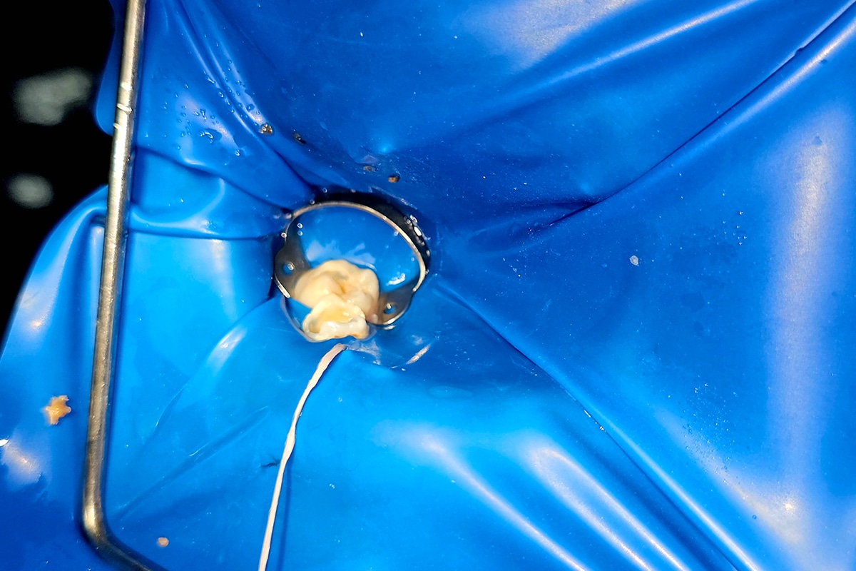 What is a pulpotomy what parents need to know about baby tooth root canals blog
